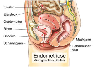 Endometriose_typische_Stellen